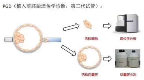 多囊卵巢综合征患者的第三代辅助生殖选择与费用解析